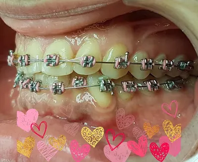 Nowoczesna ortodoncja lek. dent. Aleksandra Bonca MSc Kieferorthopeadie